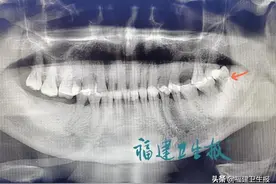 福建63岁老人因为一颗牙，住进ICU大半个月！牙疼不要忍，疼起来真要命图片