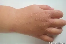 湿疹、带状疱疹，擦什么好得快？图片