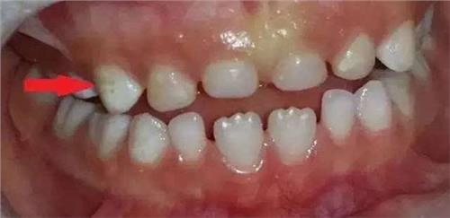 门牙上有白斑怎么办