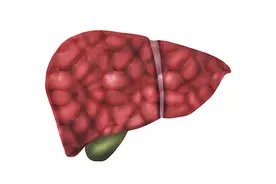 从乙肝到肝硬化仅用一年，小伙到底做了啥？提醒：3个错误别再犯图片