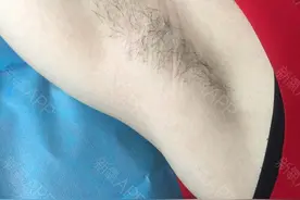 女生脱腋毛最好的方法有哪些？图片