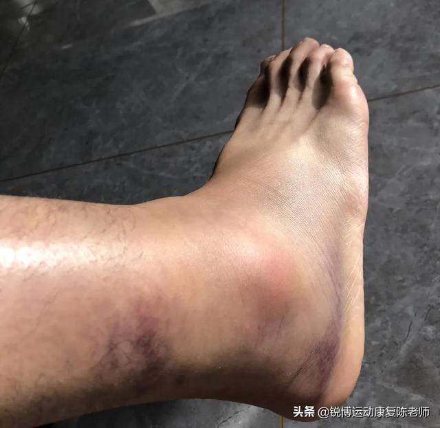 脚踝损伤如何恢复时间,脚踝扭伤需要多久恢复? - 冷求网