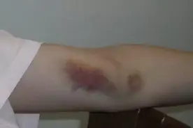 睡梦中出血，这不是鬼故事，而是一位血液病患者的真实生活图片