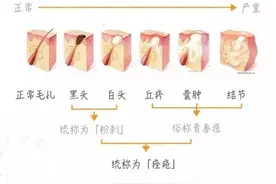 挤闭口粉刺能好吗？图片