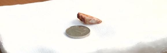 小孩好好的皮肤变成了鸡皮肤