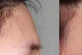 千万不要做脂肪填充，听说吸收“太快”？图片
