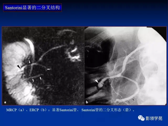 胰腺的解剖与常见变异