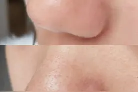 新手刷A醇2个月记录，毛孔变小皮肤变干净，简直是现实版磨皮图片