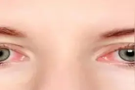 为什么起床发现眼睛有红血丝图片