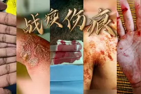 丘疹、红斑、溃疡、化脓……这些伤痕，是戍边的印记！图片