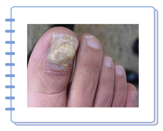 腐烂,分层此时真菌会跑到指甲下面从内部搞破坏另一种则是甲下真菌病