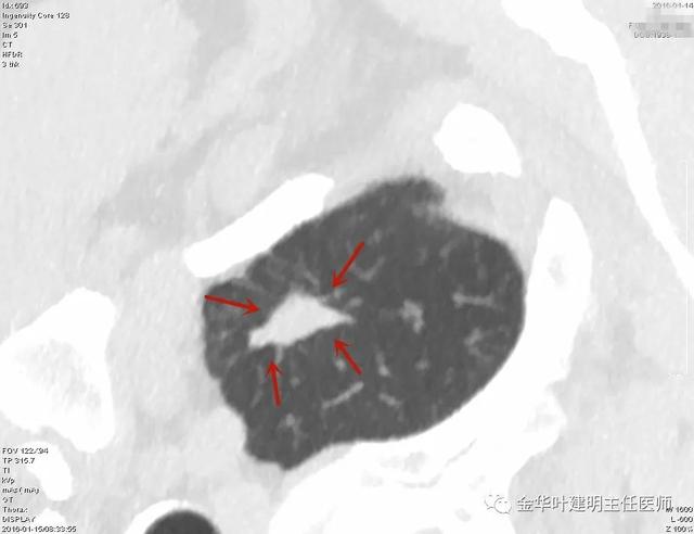 叶建明谈结节：检查发现肺实性结节怎么办？个人版实用指南