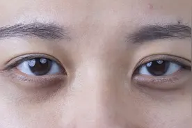 眼袋黑眼圈怎么办？只需2步就可消除，快来试试吧图片