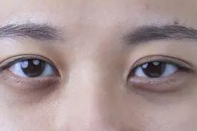 眼袋黑眼圈怎么办？只需2步就可消除，快来试试吧图片