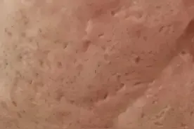 长痘后留下痘疤该怎么修复？图片