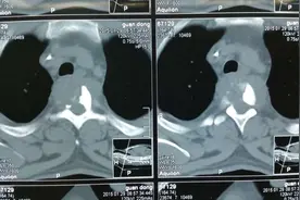 先天性颈椎齿状突畸形，是什么原因导致？患者的临床表现有哪些？图片
