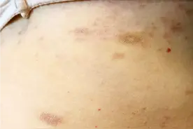 玫瑰糠疹会传染吗图片