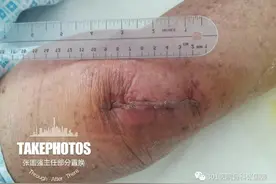 小手术解决大问题——部分膝关节置换术图片