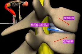 若您患有腰椎间盘膨出，不知怎么办？孔医生教您3种最核心的方法图片
