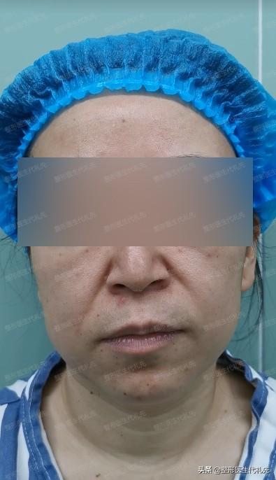 从整形医生的角度谈一谈皮肤松弛下垂的改善方法