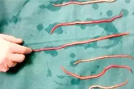 胆囊炎是怎么引起的？其中一个原因是：蛔虫！视频封面
