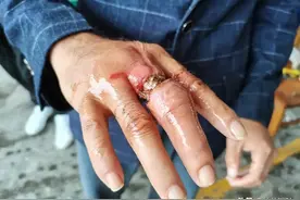 紧急！桂林一男子戒指卡手致皮肉溃烂图片