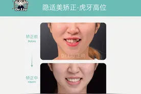 厦门牙齿矫正：隐适美牙套为什么那么贵？图片