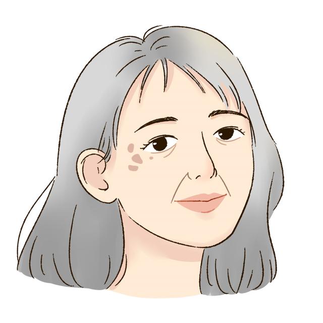 鼻根脂溢性角化病