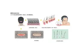 影响植发效果的重要原因之一：植发技术图片