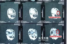 男子崴了脚不当回事，半年后，可怕的一幕出现了图片