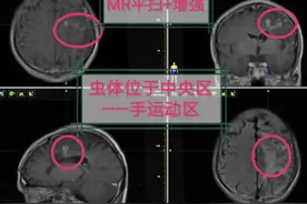 边背诗边开颅捉虫！7厘米虫子寄生脑内7年被“活捉”图片