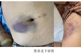 庆祝中国医师节哈医大一院科普及新技术系列报道丨血管外科:打破动脉手术禁忌 挽救熊猫血、血液高凝患者生命图片