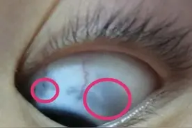 眼白上有“黑点”甚至“黑斑”是咋回事？图片
