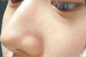 生理盐水太牛了！居然把我的痘痘痘印黑头都去掉了图片