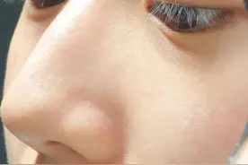 生理盐水太牛了！居然把我的痘痘痘印黑头都去掉了图片