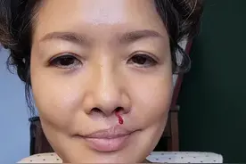 TVB著名女星拍剧突然面瘫，全身麻醉动手术，至今仍时不时流鼻血图片