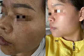 斑点治疗很简单图片