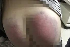 重庆6岁女生未完成作业遭老师惩罚，用带齿按摩板打伤入院，当事老师称跪下道歉都可以，教委警方已介入调查图片