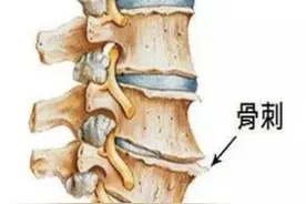 辟谣：骨刺贴膏药，按摩能消除？医生说：别急，有骨刺是好事图片