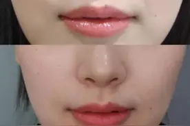 肉毒素和玻尿酸都能除皱，注射哪个更好呢？医美专家给你分析一下图片