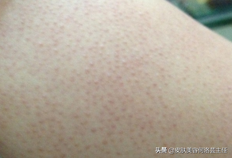 胳膊上有鸡皮疙瘩怎么治