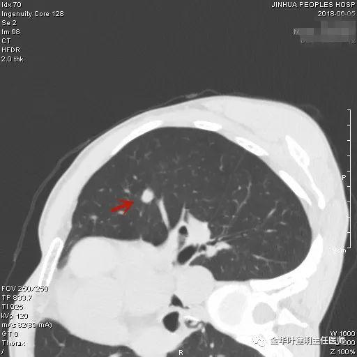 叶建明谈结节：检查发现肺实性结节怎么办？个人版实用指南