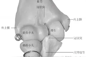 临床如何准确识别冠状突骨折？图片