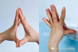 北京积水潭医院烧伤科患者康复期功能锻炼系列——手部图片
