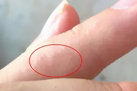 手上时不时起几个透明的小水泡，是大病的预兆吗？图片