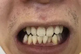 经历360元洗牙后——不洗牙，永远不知道牙齿有多脏图片