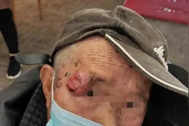 眼睑长个不痛不痒的小疙瘩，没想到竟是恶性肿瘤！多发于这类人群图片