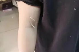 针灸治疗腰痛肩痛案例二则图片