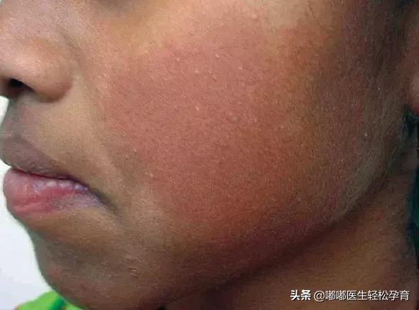 温度高对毛周角化