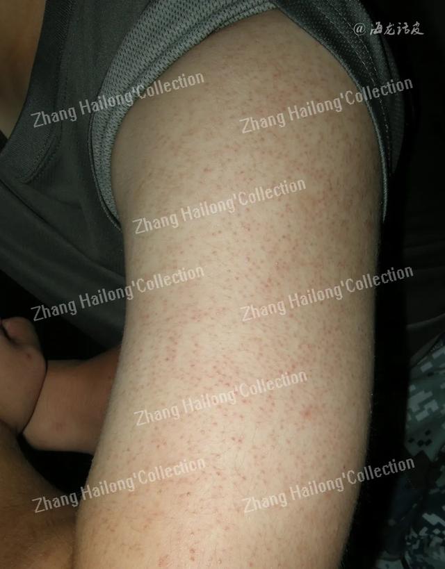 红斑角化症外用药